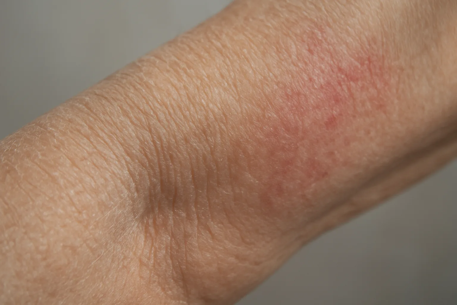 건조하여 각질이 일어난 노화 피부와 붉은 발진이 생긴 피부의 표면적 차이를 보여주는 모습